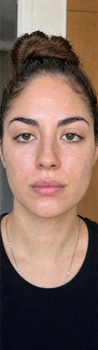 Emma R., after Day 90: hormonal acne