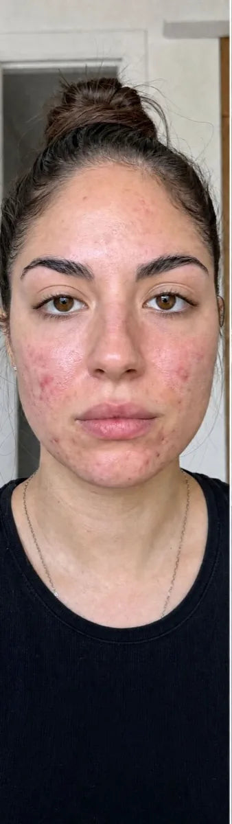 Emma R., before: hormonal acne