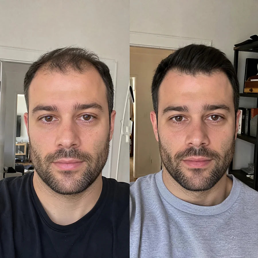 Hair density before and after &mdash; Apex cold atmospheric plasma, result 1 of 12