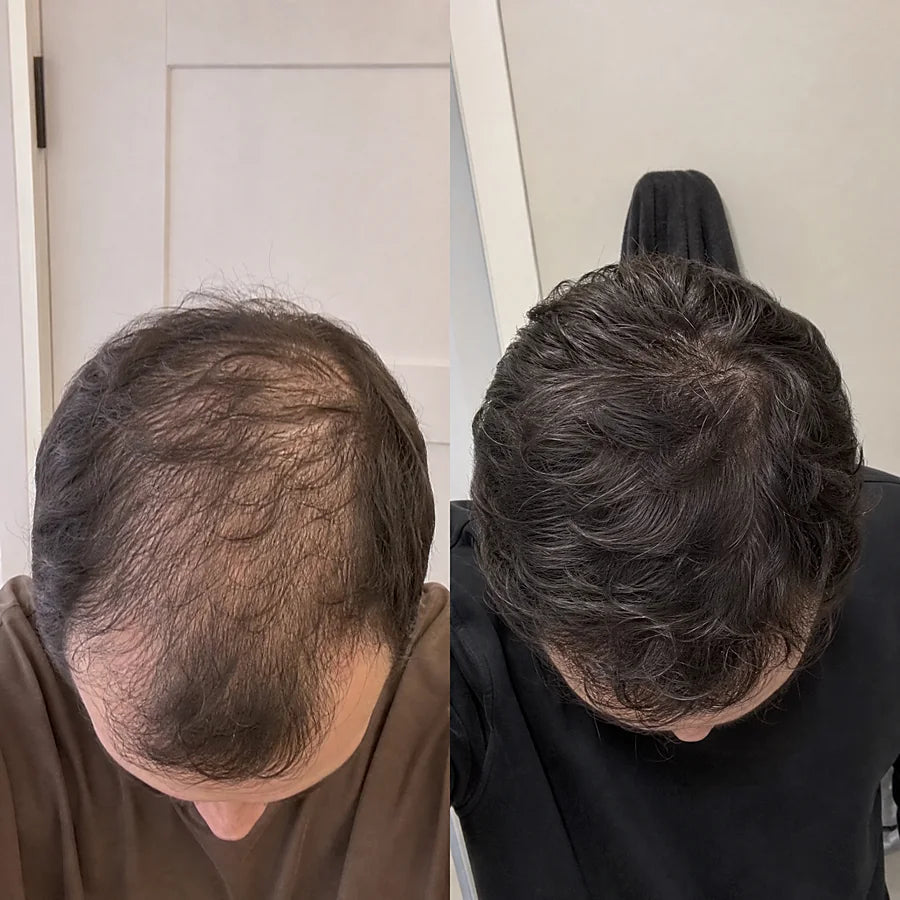 Hair density before and after &mdash; Apex cold atmospheric plasma, result 10 of 12