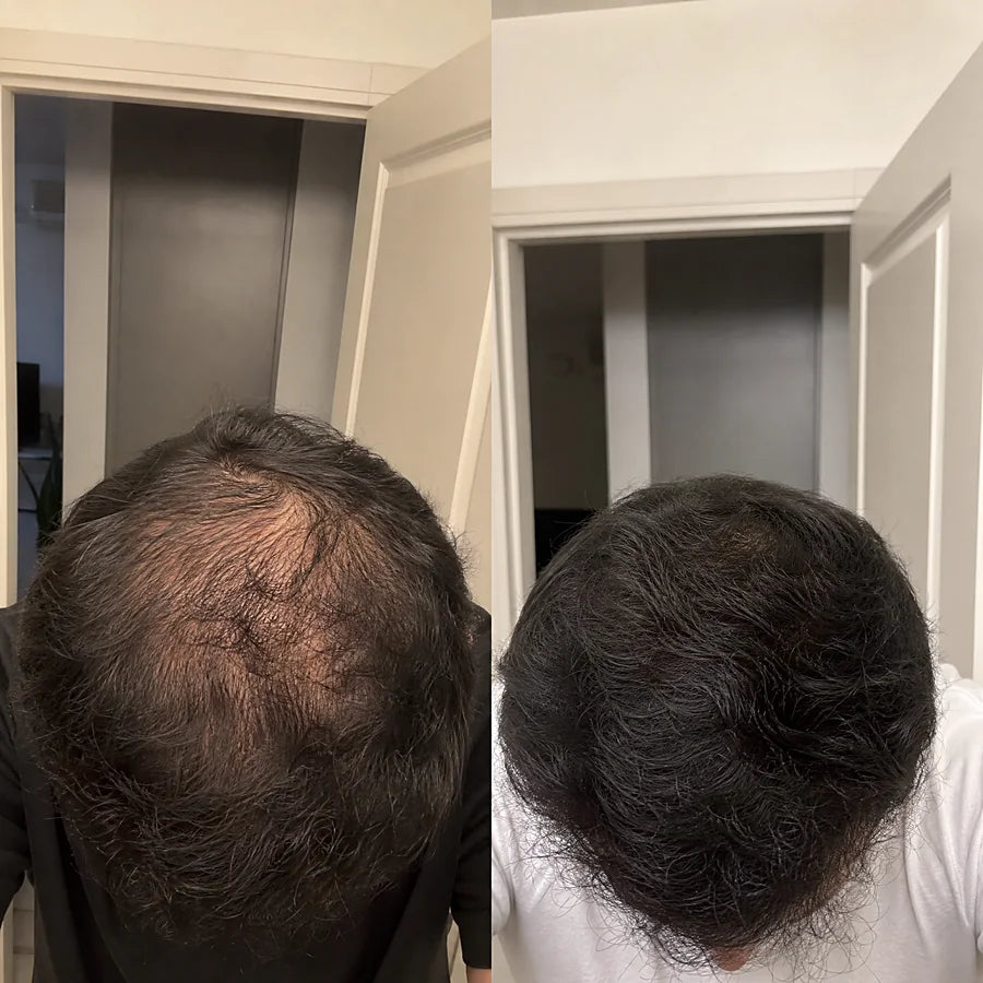 Hair density before and after &mdash; Apex cold atmospheric plasma, result 11 of 12