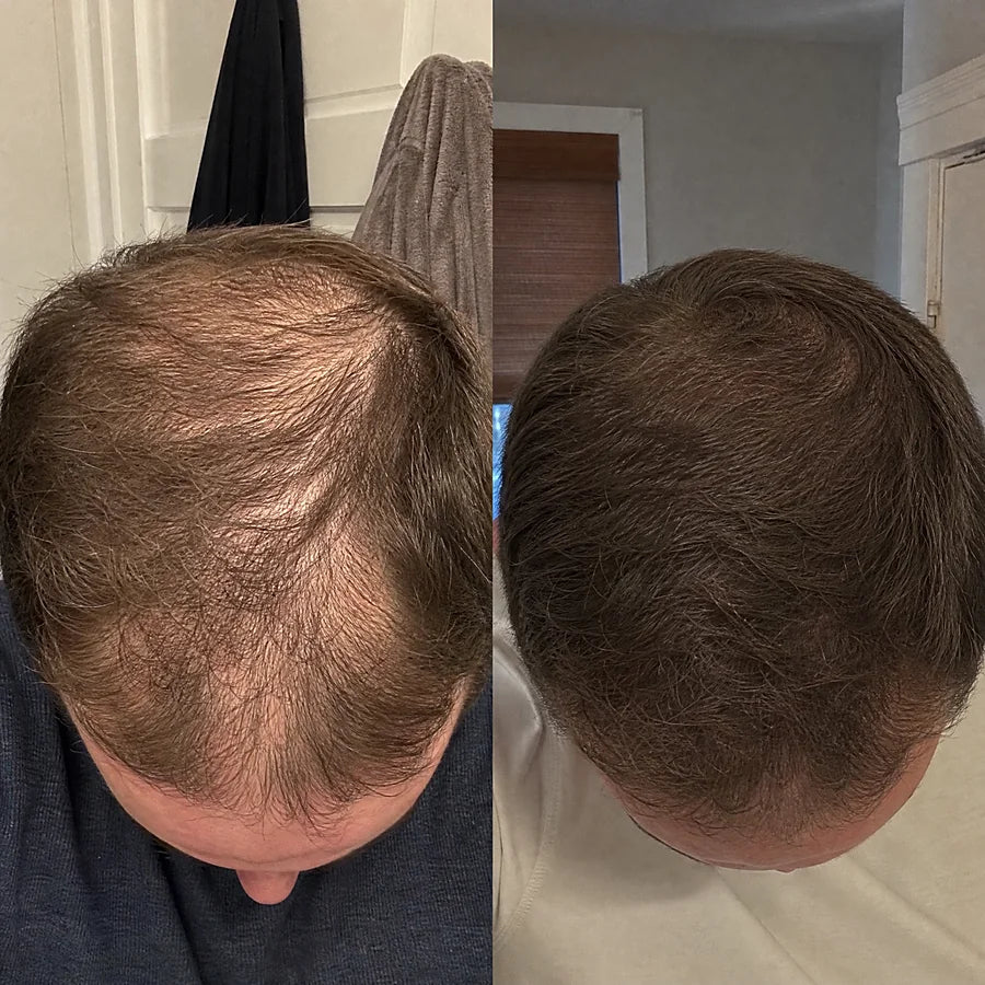 Hair density before and after &mdash; Apex cold atmospheric plasma, result 12 of 12