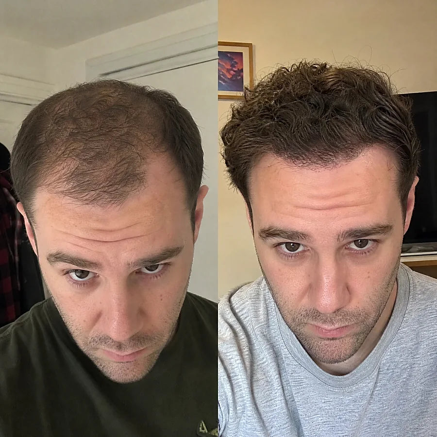 Hair density before and after &mdash; Apex cold atmospheric plasma, result 2 of 12