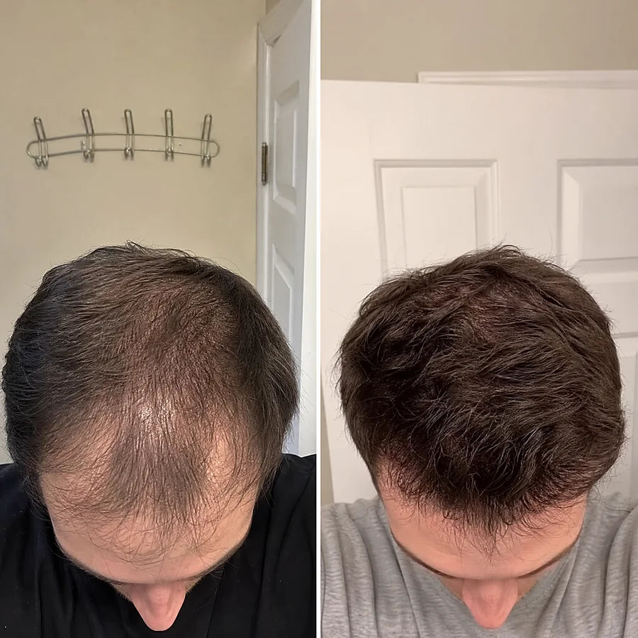 Hair density before and after &mdash; Apex cold atmospheric plasma, result 3 of 12
