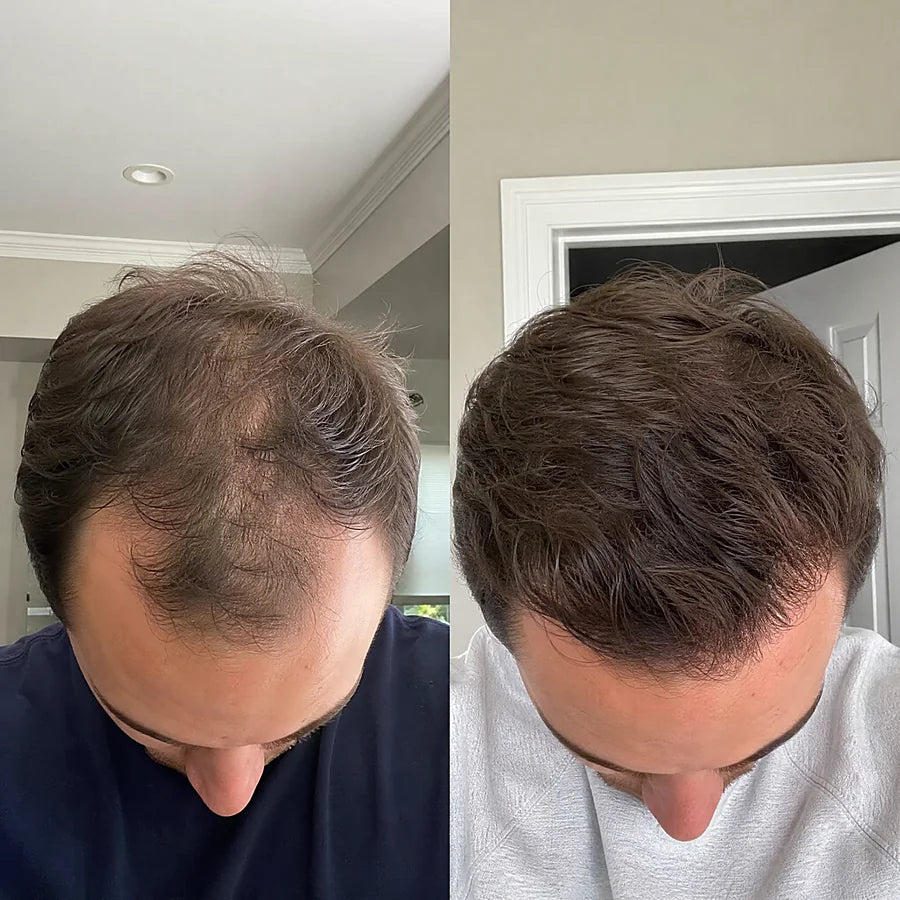 Hair density before and after &mdash; Apex cold atmospheric plasma, result 4 of 12