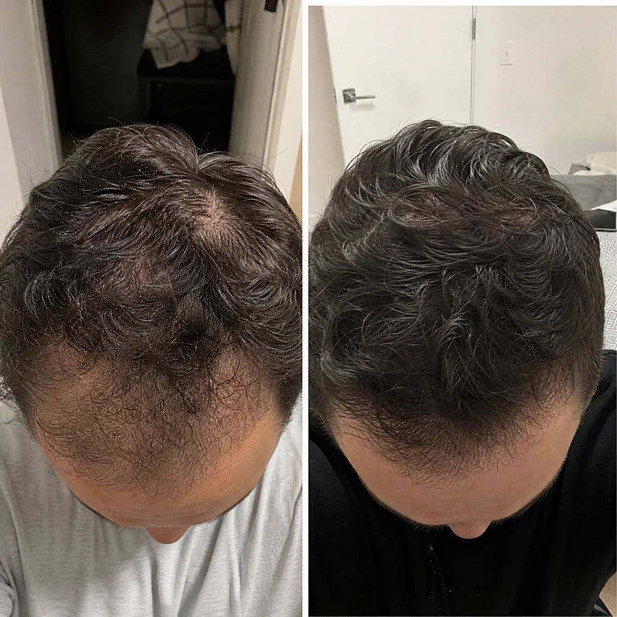 Hair density before and after &mdash; Apex cold atmospheric plasma, result 5 of 12