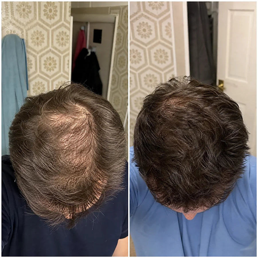 Hair density before and after &mdash; Apex cold atmospheric plasma, result 6 of 12