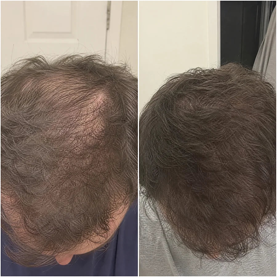 Hair density before and after &mdash; Apex cold atmospheric plasma, result 7 of 12