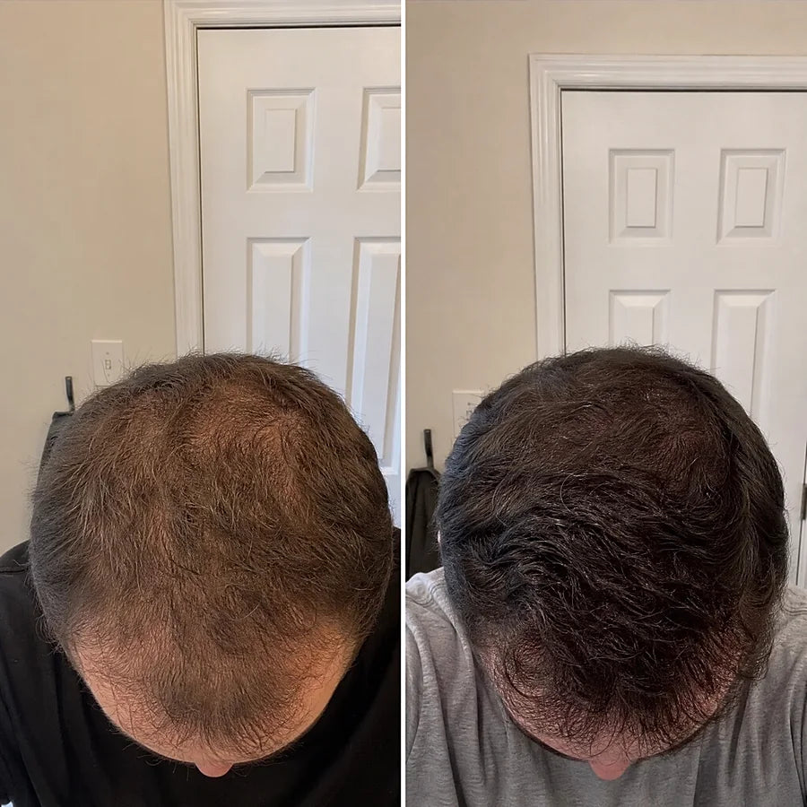 Hair density before and after &mdash; Apex cold atmospheric plasma, result 8 of 12