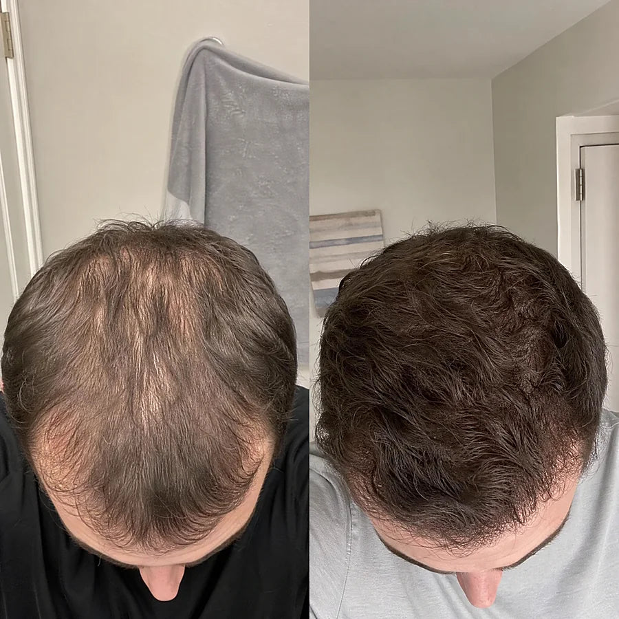 Hair density before and after &mdash; Apex cold atmospheric plasma, result 9 of 12